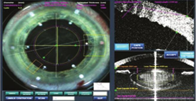 Effect of femtolaser assisted cataract surgery on postoperative macular edema BEVEZETÉS A femtoszekond lézer intraocularis alkalmazása új távlatokat nyitott a refraktív sebészetben, mivel foto -