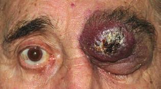 Merkel cell carcinoma in the eyelid AMerkel-sejtes karcinóma (MCC) a bőr igen rosszindulatú ritka neuroendokrin daganata, amely főleg idősebb korban keletkezik.
