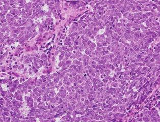 A tumor mélyen infiltrálta az orbicularis izmot, a tarsus azonban ép volt.