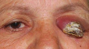 Merkel cell carcinoma in the eyelid igazolt (II. stádium). A beteg elutasította a további terápiás beavatkozásokat, túléléséről nincs adatunk. 4.