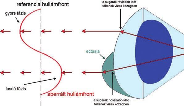 A hullámfront-analízis alapjai és klinikai alkalmazása 7.
