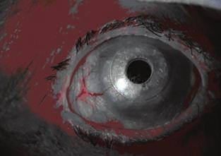 First results with a modified Konstantinov-type keratoprosthesis implantation 3. ábra: Előemelkedő, extrém száraz szemfelszín és protézis, első beültetés, 22 hónappal a műtét után. Visus 0,63 4.