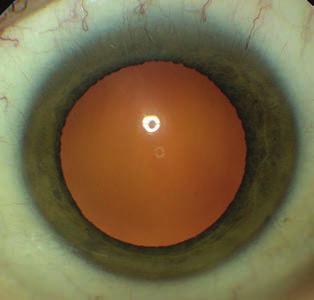 Initial results of femtolaser cataract surgery 3.