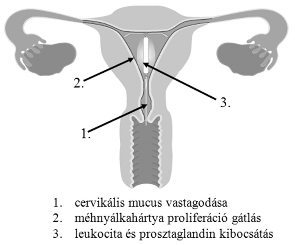 az ösztrogén receptor érzékenységét csökkenti. Kezdetben a hatóanyag-leadás mértéke 20 μg/nap levonogestrel.