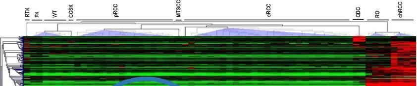 5. Ábra Vesedaganatok génexpresszós profilja microarray vizsgálattal.