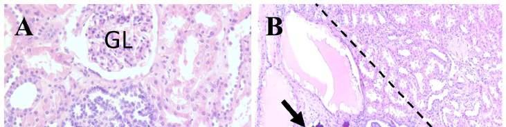 . 8. Ábra. A: Egy glomerulusnál alig nagyobb kis kék sejtes papilláris prekurzor lézió, amely intralobulárisan helyezkedik el.