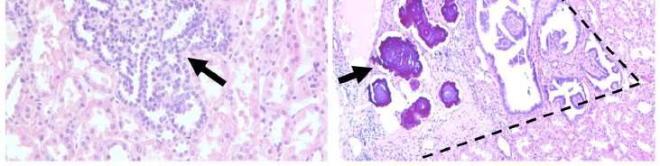 A papilláris vese tumorok szövettani heterogenitása A papilláris vese tumorok szövettani képe nagyfokú heterogenitást mutatott. A papilláris tumorok sok esetben hasonló szövettani képet mutattak (9.