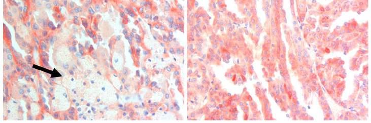 C: egy papilláris vesetumor kifejezett habos sejtes infiltrációval (nyíl). D: Diffuz MET pozitivitást mutató papilláris vese tumor. 4.5.
