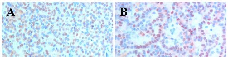 18. Ábra. HNF1B pozitivitás két papilláris vese tumorban.