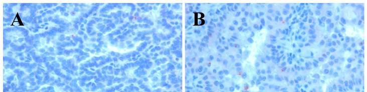 25. Ábra. PCDH11XY immunhisztokémia. Mind a kis sejtes korai stádiumban lévő papilláris vesetumorban (A) mind a többmagsoros hámmal borított papilláris veserákban (B) negatív eredményt kaptunk. 5.