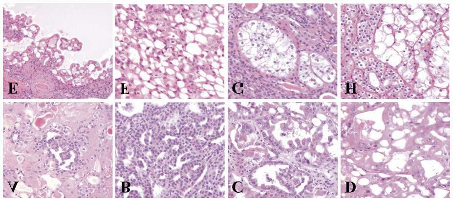 ANTICANCER RESEARCH 38: 5217-5222 (2018) Figure 1. Morphological heterogeneity of precursor lesions and ESRD/ACRD tumors.