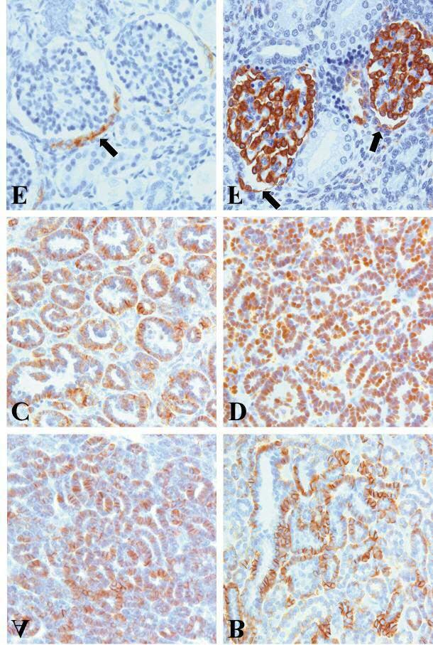 Sarlos et al: Origin of Metanephric Adenoma Figure 1. Immunohistochemistry of CDH17 and WT1. (A) Positive staining with anti-cdh17 antibody in a tubular growing metanephric adenoma.