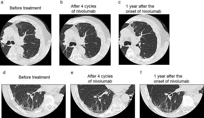 Nivolumab IPF+tüdőcarcinoma (eset