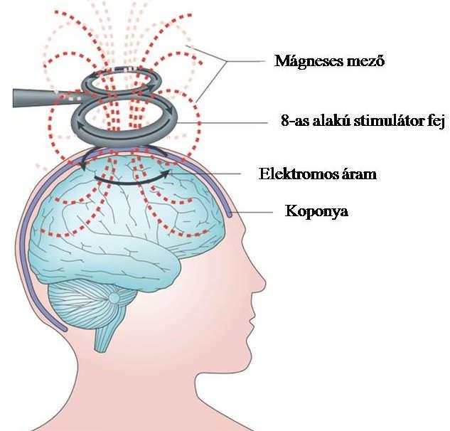 A 3.2. ábra szemlélteti a készülék működését, a 3.3. ábra pedig a gép felépítését. 3.2 ábra: a TMS működése (93) 3.3. ábra: Az rtms készülék felépítése Rövidítések: Vs: a TMS gép feszültsége; Rs: a