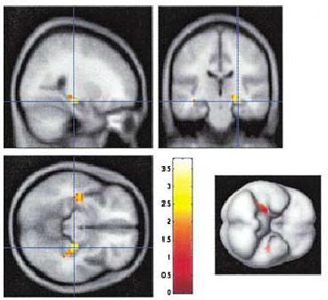 Agyi eredetű növekedési faktor (Brain-Derived Neurotrophic Factor [BDNF]) 4.