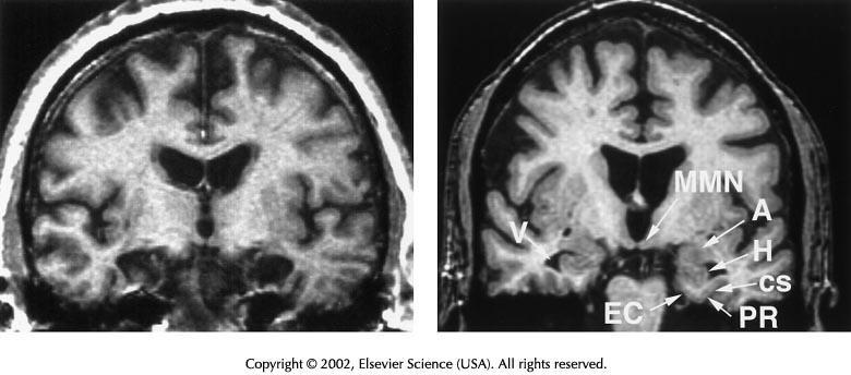 H.M.: A múltban ragadt ember HM Kontroll Anterograd amnesia: új események, személyek és szavak megjegyzésének képtelensége - Megtartott: IQ Rövid távú