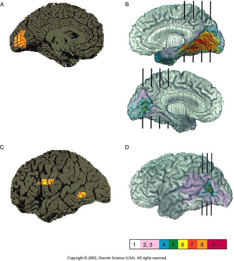 Agnosia: tárgyak, személyek, szavak felismerési képtelensége, a jelentéstartalom elvesztése (szemantikai szintű zavar) Élőlények felismerésének zavara