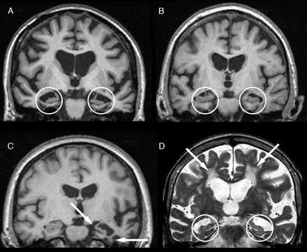 A medialis temporalis struktúrák eltérései különböző típusú demenciákban A. Alzheimer-kór B.