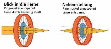 összehúzódott zonula rostok lazák, lencse