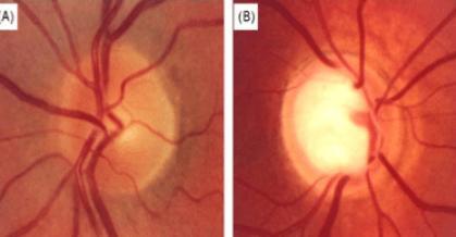 Glaucoma