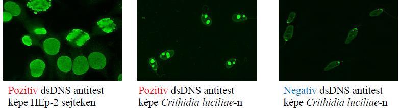 ANA tesztek Anti-(natív) DNS antitest (Anti-ds-DNS) = anti-kettősszálú DNS= duplaspirálú DNS elleni antitest: - az SLE diagnózisához szükséges, de a betegség monitorozására is alkalmas.