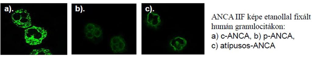 Anti-neutrofil citoplazma antitestek (ANCA) - Neutrofilek és monociták citoplazmájában lévő antigének elleni antitestek gyűjtőneve - fontosabb formái: - proteináz 3 (PR3), - myeloperoxidáz (MPO), -