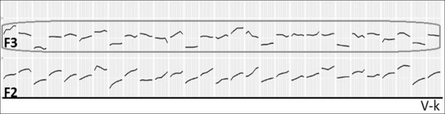 Formánsok a nyelv és a beszélő tükrében 33 A legkisebb szórás érték az /E l: E h E/ hangsorban van. Itt a középső /E/ hangban az F 3 közel vízszintes vonulatot mutat a mért 60 ejtésben (5. ábra).