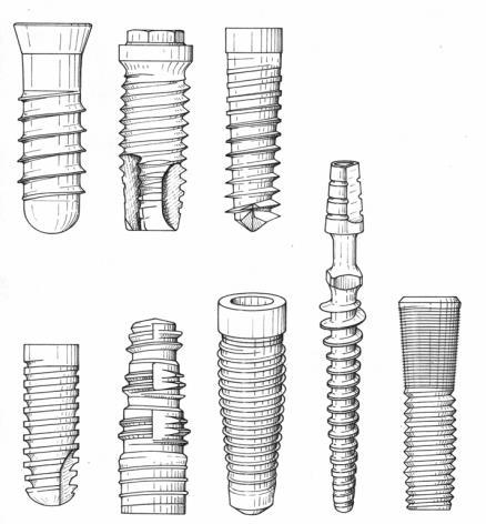 Csontsűrűségi osztályok és jelentésük Fogászati implantátumok stabilitása Az implantátum biomechanikai funkcióját csak annyira megfelelően tudja ellátni, amennyire stabilan csatlakozik az őt