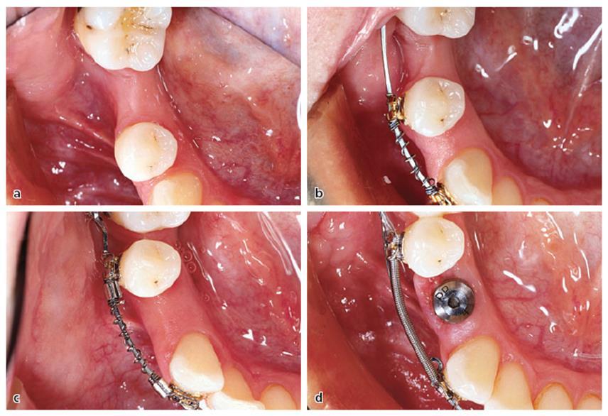 Testes mozgatás alveolusaugmentációhoz Lindhe J. Lang N. P. Karring T.