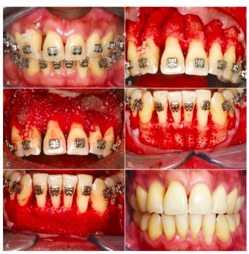 Kortikotómia alveoláris csont remodellálódása a kulcsa a