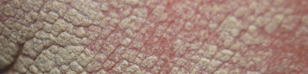 PSORIASIS