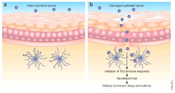 Epidermális barrier sérülés következménye AD-ben A bőrbarrier