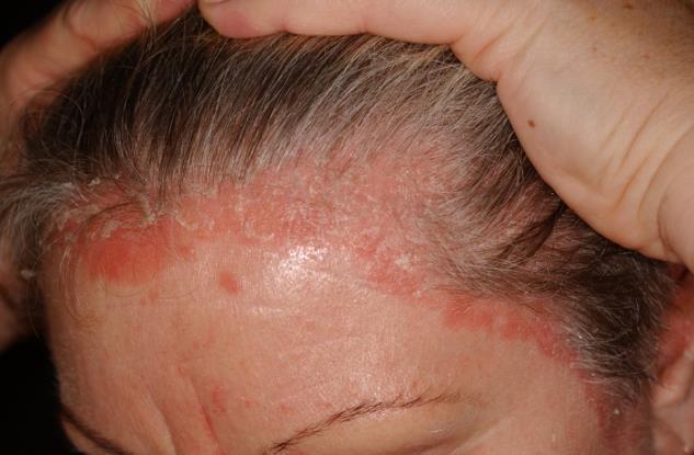 Psoriasis