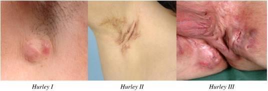 Hydradenitis suppurativa Krónikus gyulladásos