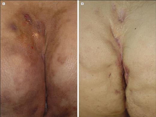Adalimumab (Humira) hidradenitis