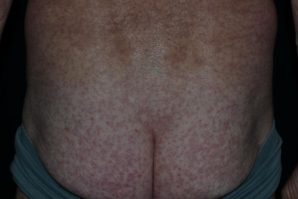 Nivolumab kezelés során jelentkező