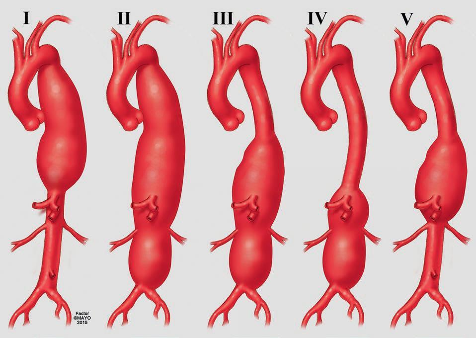 4. ábra A thoracoabdominalis aneurizmák Crawford osztályozása Safi szerint módosítva 16 1.4.2 Akut aorta szindróma Akut aorta szindrómaként foglaljuk össze az aortát érintő azon sürgősségi kórképeket, melyek klinikai megjelenése és kezelése igen hasonló.