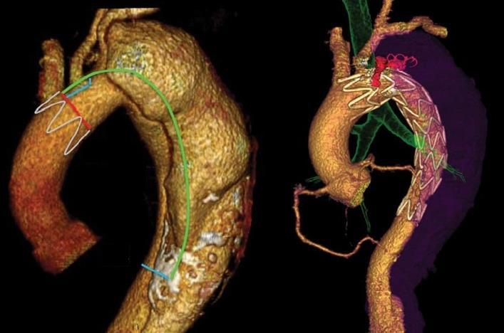 7. ábra Egyedileg gyártott mellkasi grafttal sikeresen megoldott eset preoperatív és kontroll CTA felvétele (saját anyag) A Z1 pozícióban rögzített graft proximalis végére egy scallop került a bal