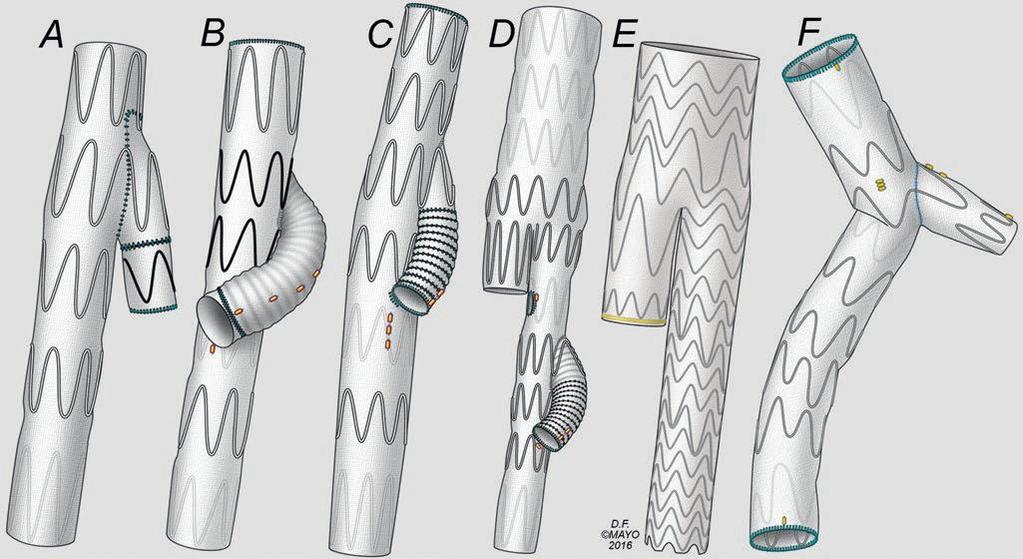 interna átjárhatóságának megtartása szükséges. Az elágazó graftok legegyszerűbb típusának tekinthető iliaca bifurkációs eszközöket (iliac bifurcation device IBD) a 9.