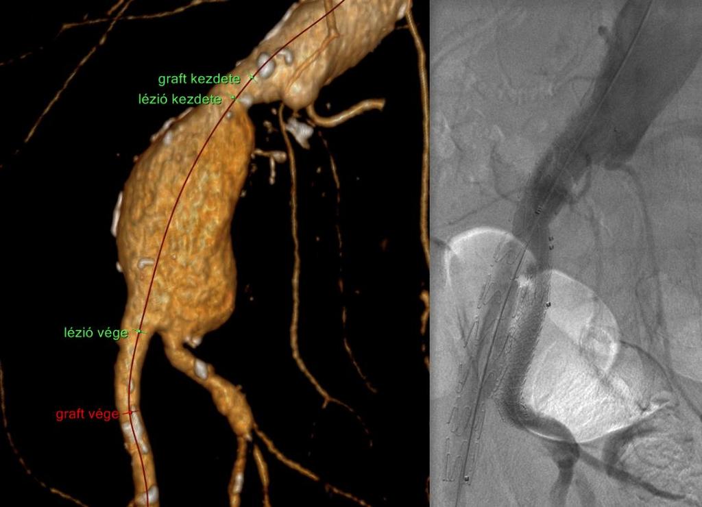 10. ábra Bal iliaca communis elzáródással komplikált jobb iliaca communis aneurizma ellátása Jotec E-Liac IBD eszközzel (saját anyag) A jobb iliaca bifurkációt is érintő iliaca