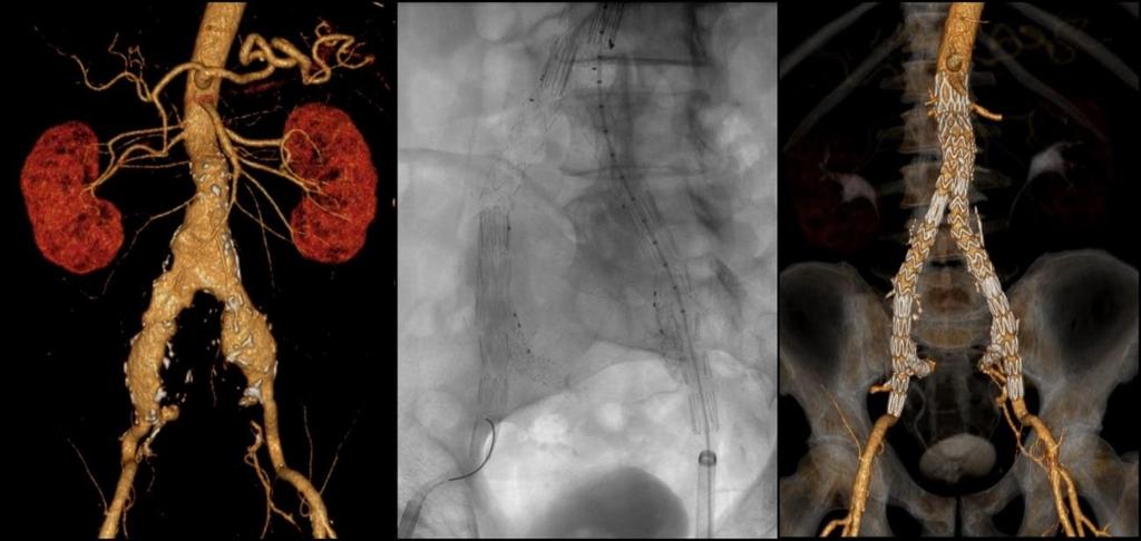 interna komponens bevezetése. Aortobiiliacalis aneurizma ellátása során ritkán mindkét oldalon iliaca bifurkációs eszköz implantációjára kényszerülünk.