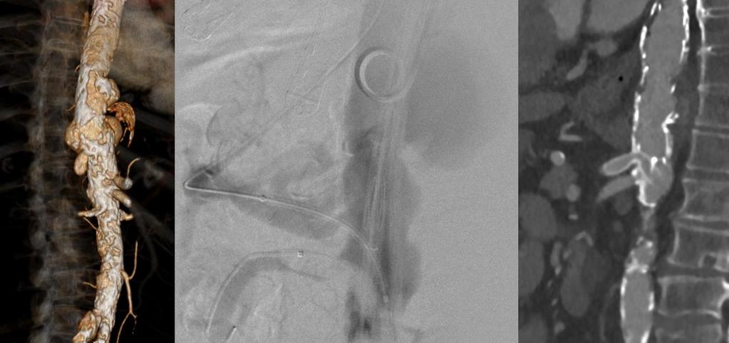 19. ábra Periszkóp graft használata a thoracoabdominalis átmenetben (saját anyag) A thoracoabdominalis átmenetben lévő többszörös, saccularis aneurizmarendszer ellátása csak a truncus coeliacus