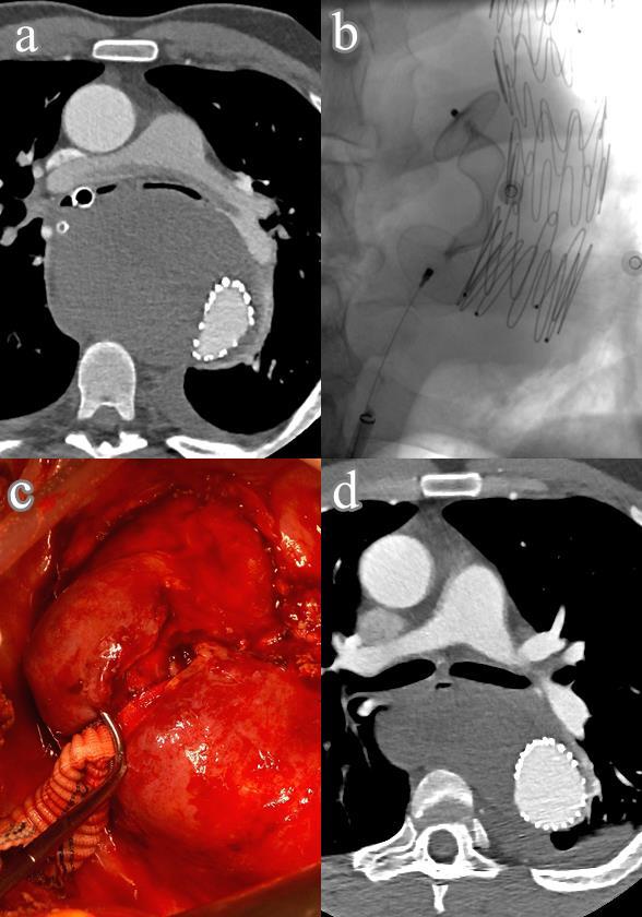 21. ábra Thoracalis stent graft implantációt követően az állumen perzisztáló átjárhatósága miatt sikeretlen endovaszkuláris okklúzió, majd nyitott műtét történt (saját anyag) Hatalmas aneurizma által
