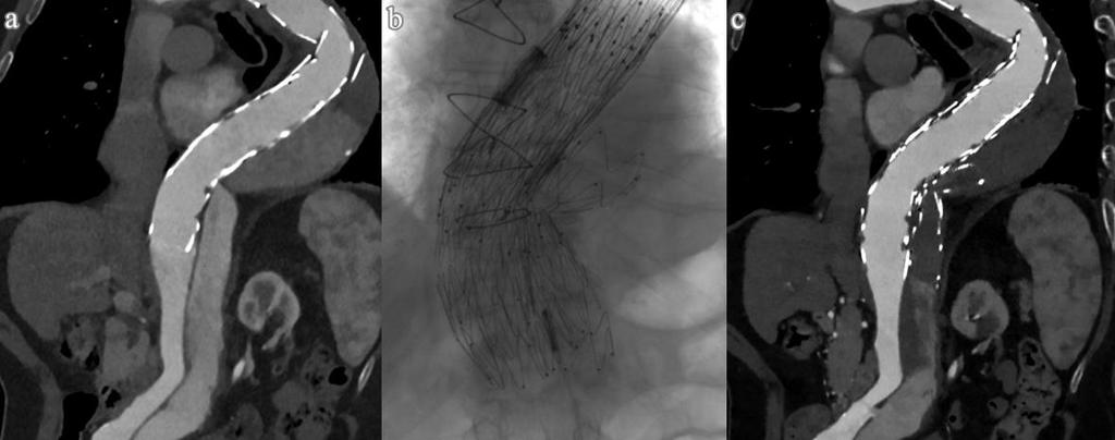 22. ábra Állumen okklúzió a candy plug eszköz használatával (saját anyag) A thoracoabdominalis átmenet preoperatív CT felvételén a korábban behelyezett graft mellett az állumen perzisztáló