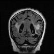 ) shunt mechanismusok hiánya Vascularis elváltozás: az agyban : ISCHEMIÁS STROKE +/- a látórendszerben : OCULARIS STROKE