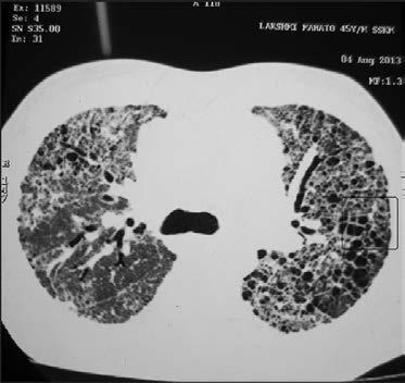 hypoxia miatt COPD