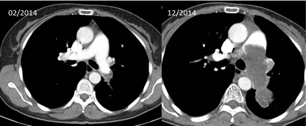 tumor arteriitis congenitalis