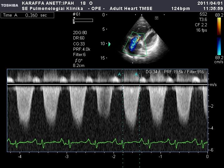 (est) 77 mmhg RVEF-TVI