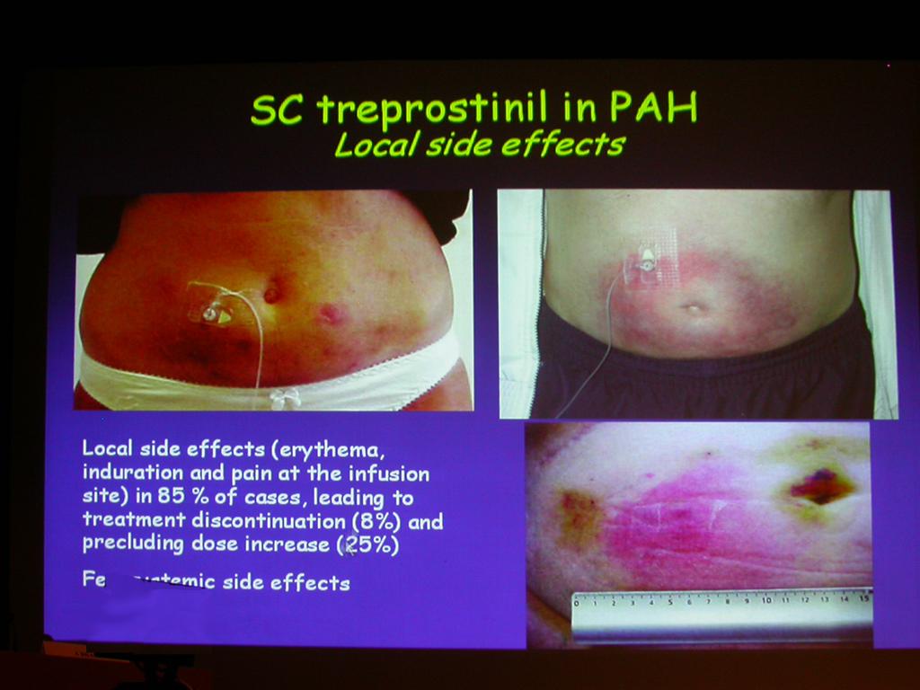 Sc Treprostinil PAH-ban lokális mellékhatások Lokális mh-k: (hyperaemia, induráció, helyi