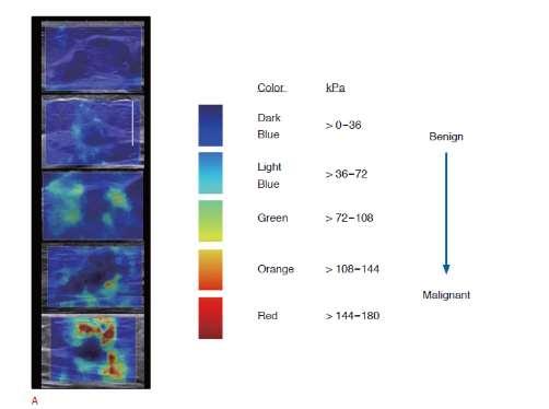 Szonoelasztográfia Mértkegysége: kpa Ábrázolás: színkódolással B/M elkülönítésében segít, de csak kiegészítő tünetként
